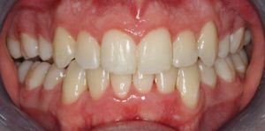 Teeth Align Before