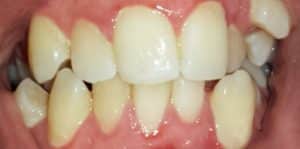 Teeth Align Before