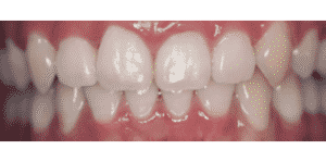 Teeth Whitening Before