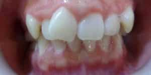 Teeth Align Before
