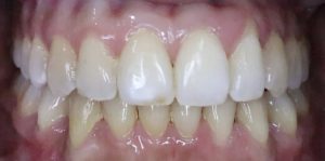 Teeth Whitening Before