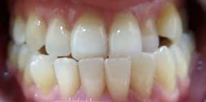 Teeth Align Before