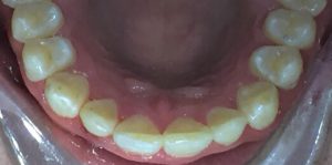 Teeth Align Before