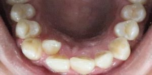 Teeth Align Before