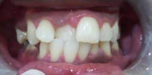 Teeth Align Before
