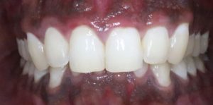 Teeth Align Before