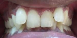 Teeth Align Before