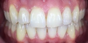 Teeth Align Before