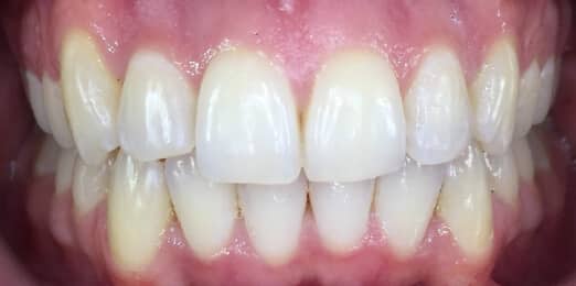 Teeth Align Before