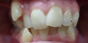 Teeth Align Before