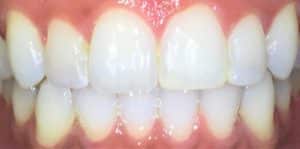 Teeth Whitening Before