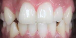 Teeth Align Before