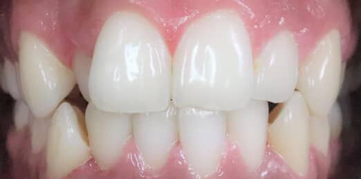 Teeth Align Before