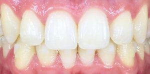 Teeth Align Before