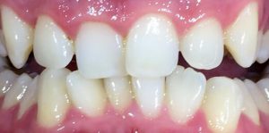 Teeth Align Before
