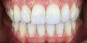 Teeth Align Before