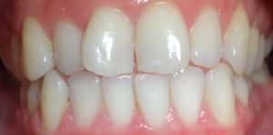 Teeth Align Before