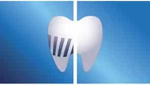 Up to 99.9% plaque removal